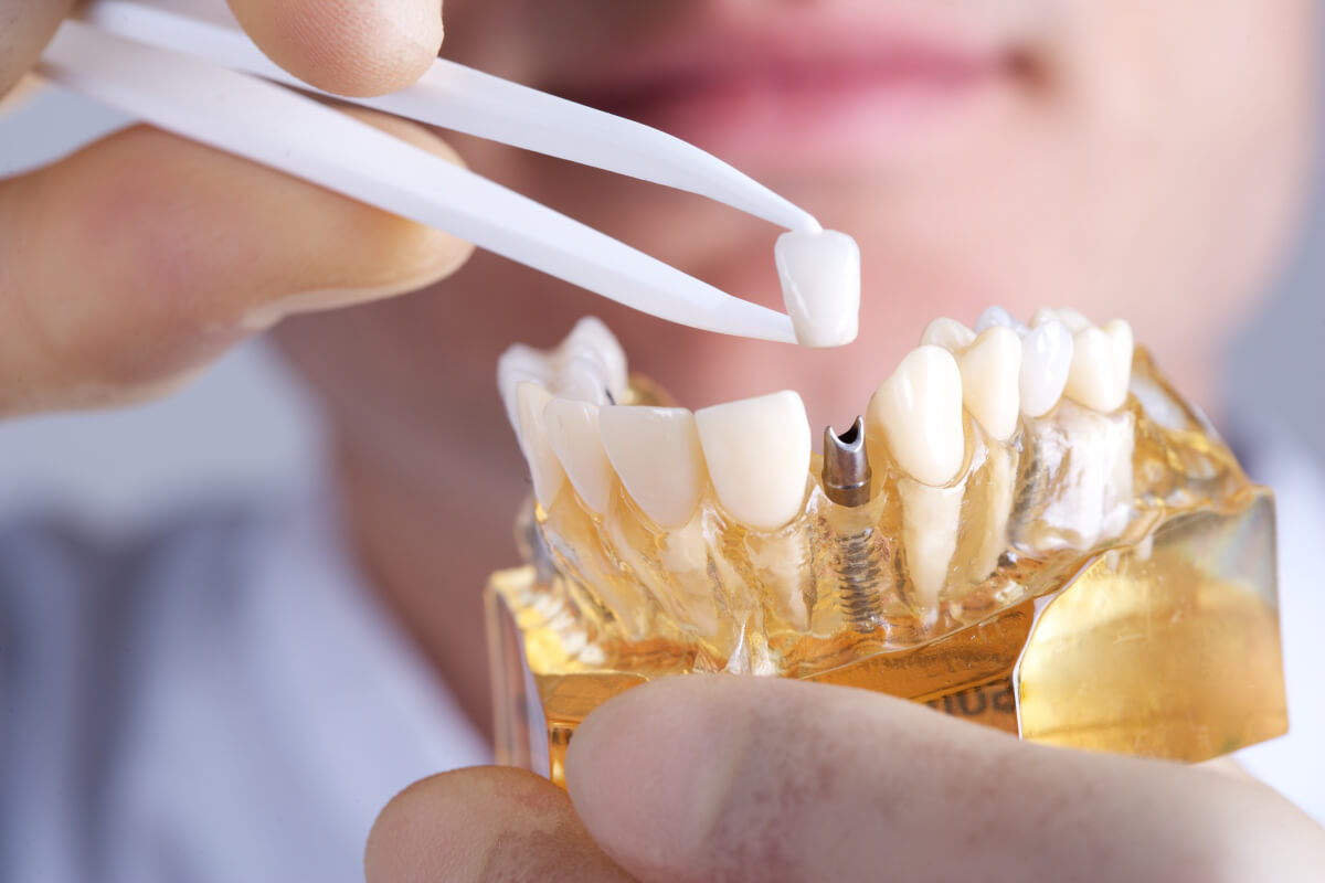 5 facts you should know about dental implants