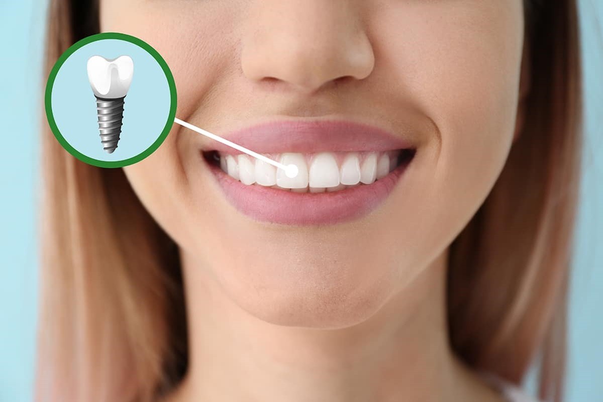 benefits of having a single tooth implant