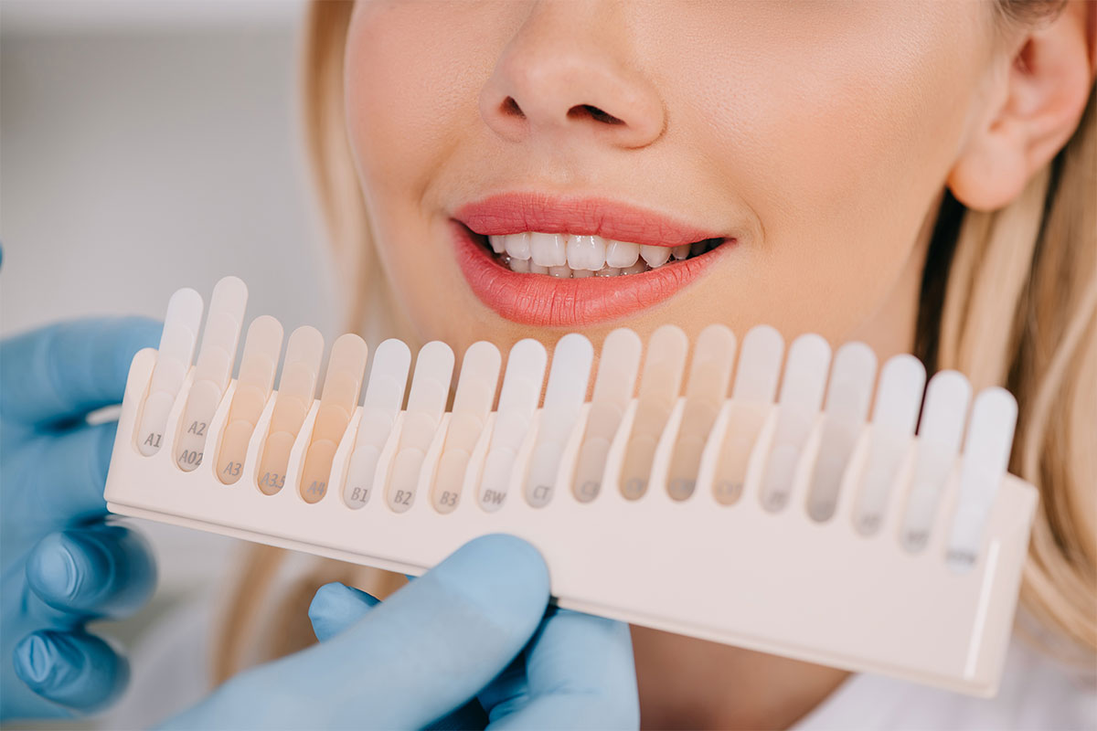 common mistakes to avoid when caring for veneers