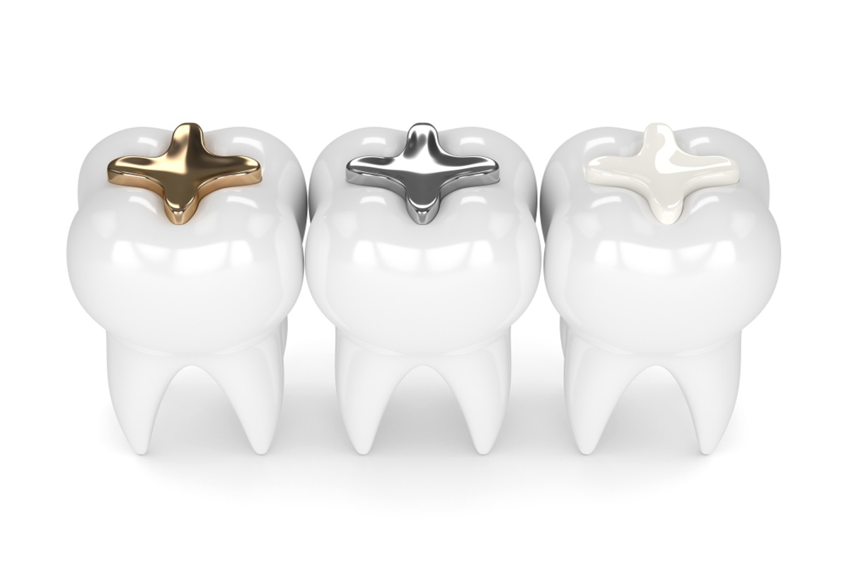 how tooth colored fillings are better than metal